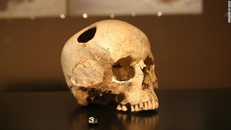 Fransa’daki Lausanne Müzesi’nde trepanasyon uygulanmış bir kafatası. Kemiklerde iyileşme izleri görüldüğünden ameliyattan sonra bireyin bir süre daha yaşadığı anlaşılmıştır. 