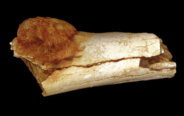 Volume rendered image of the external morphology of the foot bone shows the extent of expansion of the primary bone cancer beyond the surface of the bone [Credit: Patrick Randolph-Quinney (UCLAN)]