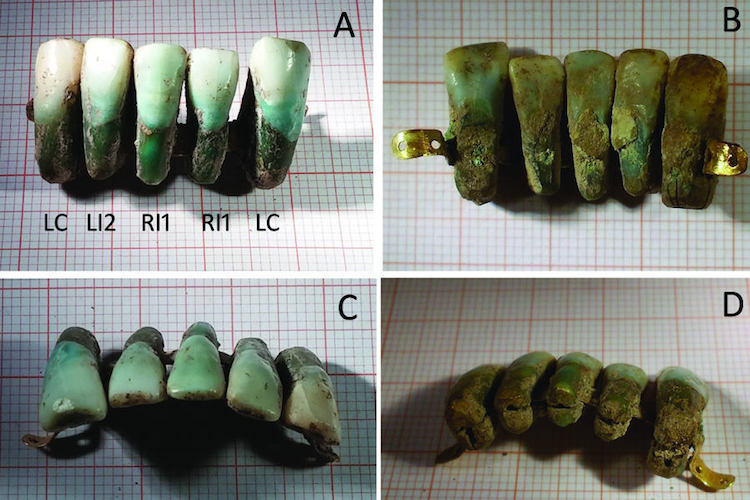 italya'da en eski diş protezi bulundu