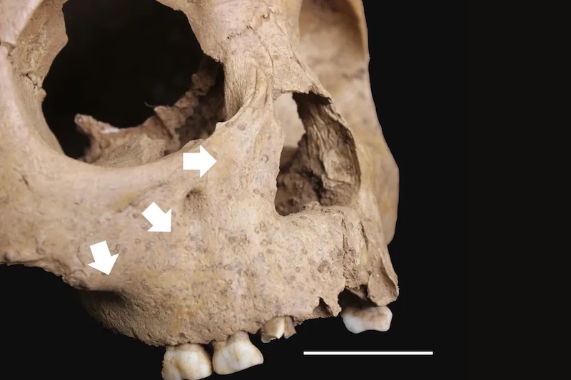 Vietnam’da 4.000 Yıl Önce Frengi Benzeri Bir Hastalık Yayılıyordu