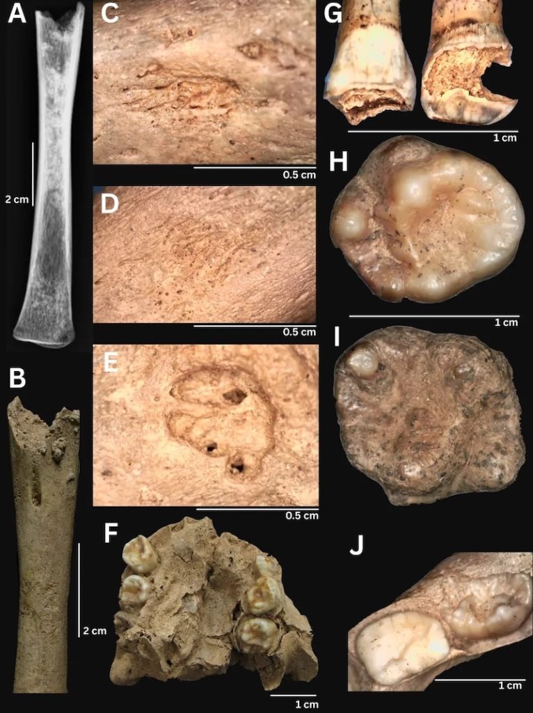 Vietnam’da 4.000 Yıl Önce Frengi Benzeri Bir Hastalık Yayılıyordu