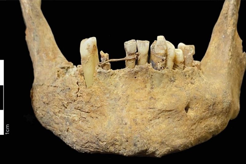 Aberdeen St. Nicholas Kilisesi'nde bulunan Orta Çağ'a ait altın diş bağı, alt çene kemiğinde kesici dişleri çevreliyor.